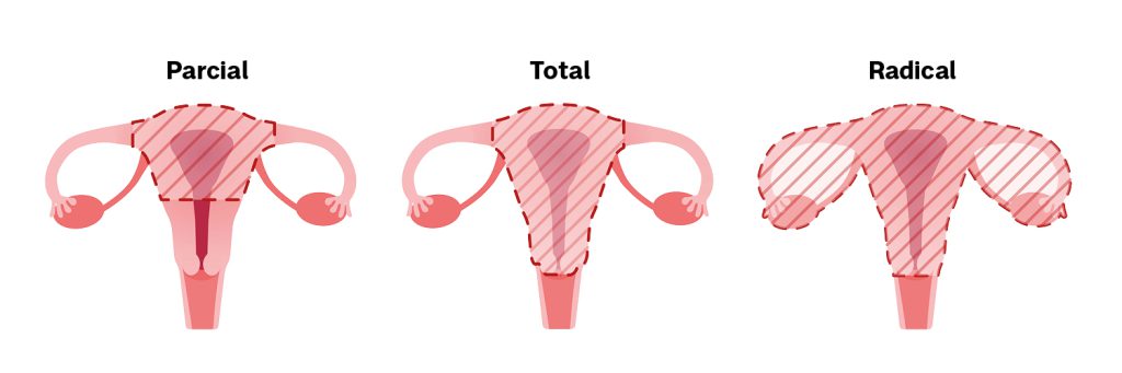 Adenomiose o que é sintomas e tratamento Nav Dasa