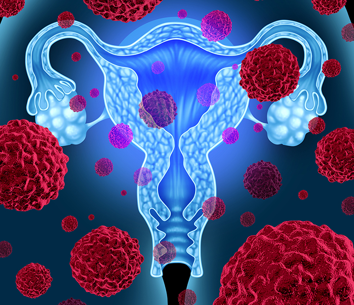Câncer de colo de útero