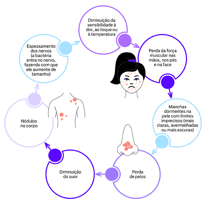 Portal eduCapes: Infográfico: Hanseníase-sintomas