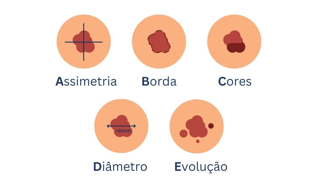 ABCDEs Câncer de pele