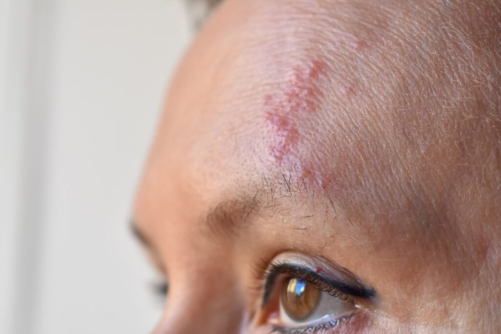 Herpes Zóster no rosto: como identificar e prevenir a doença | Nav Dasa