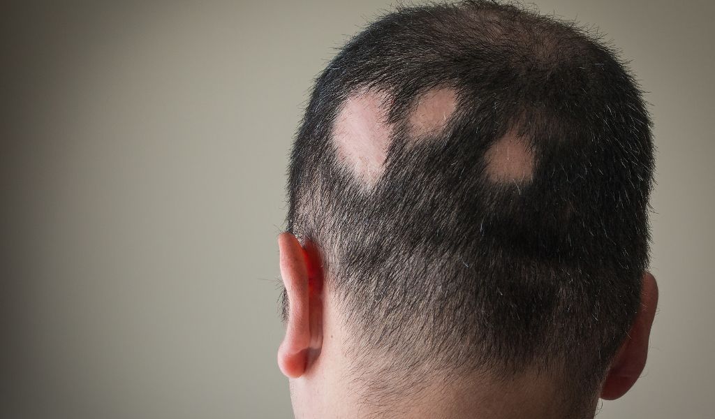 Alopecia areata: causas, sintomas e como tratar | Blog Nav