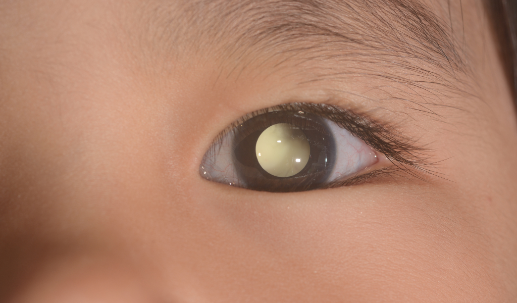Retinoblastoma: saiba mais sobre câncer ocular raro que afeta crianças
