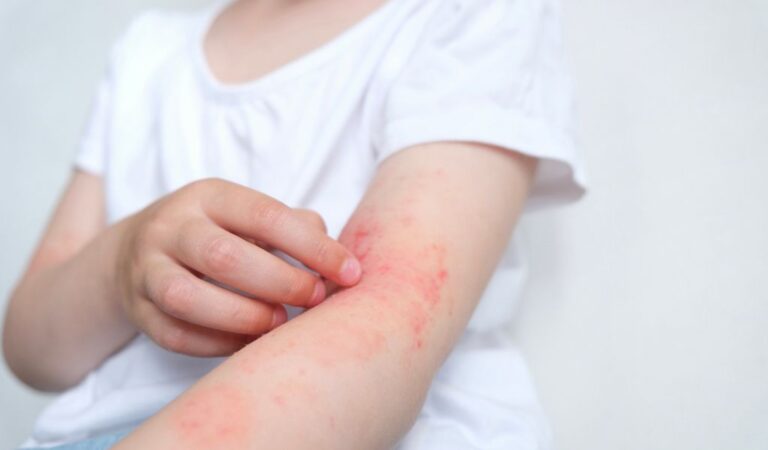Impetigo: o que é, sintomas e tratamento | Blog Nav Dasa
