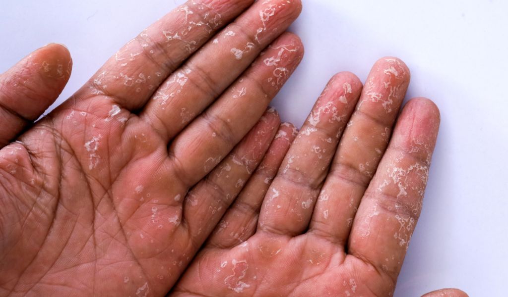 Disidrose: condição afeta a pele das mãos e dos pés