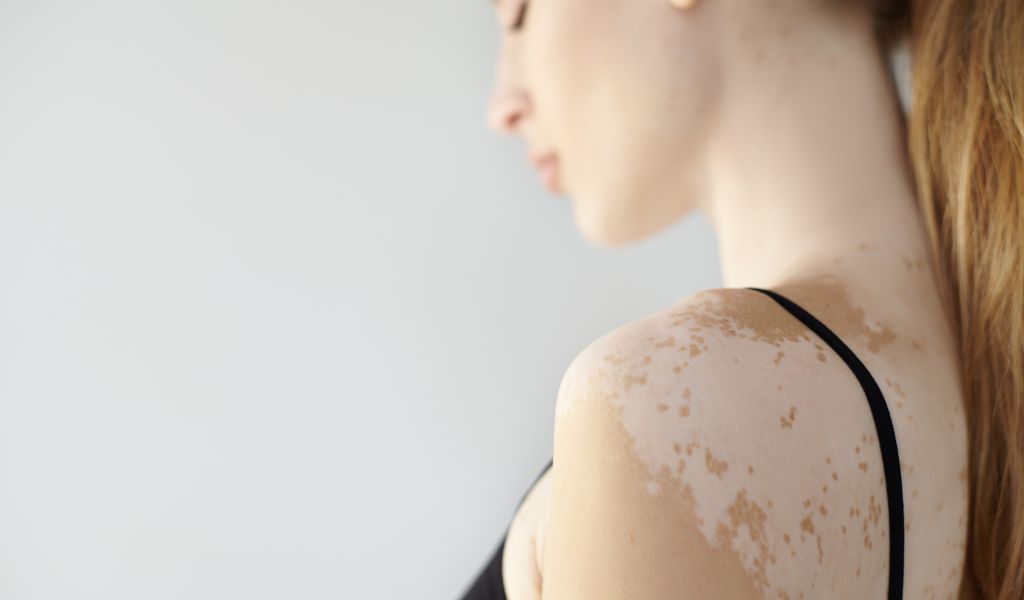 Mancha branca na pele: veja as causas e tratamentos