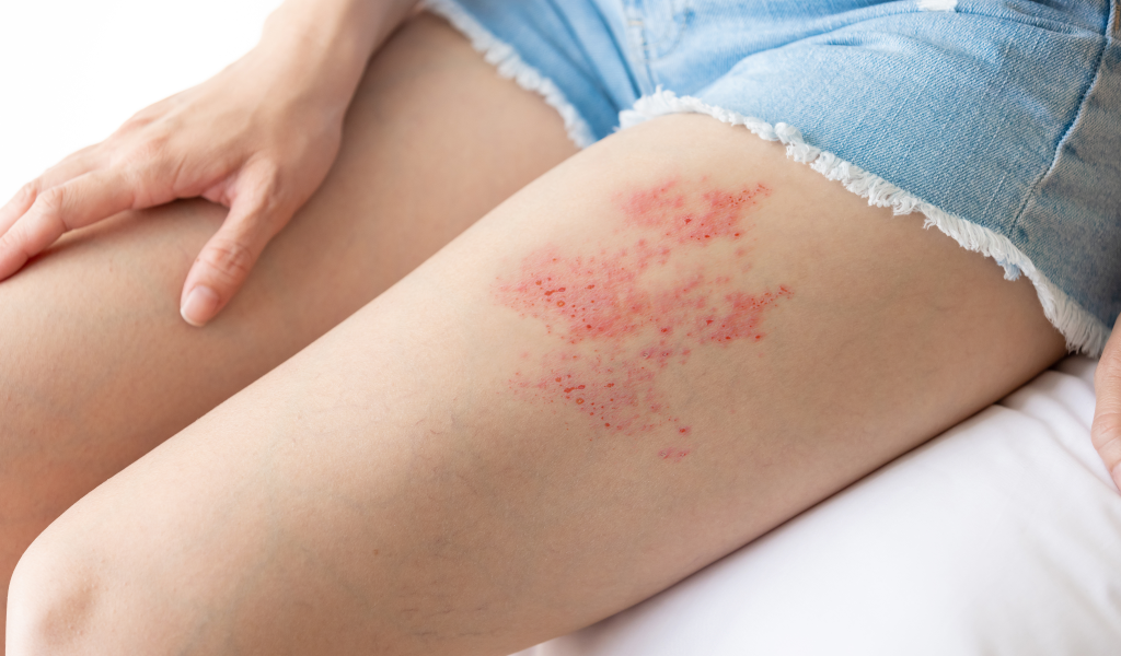 Alergia: reação do sistema imunológico provoca sintomas como coceira e dificuldades respiratórias