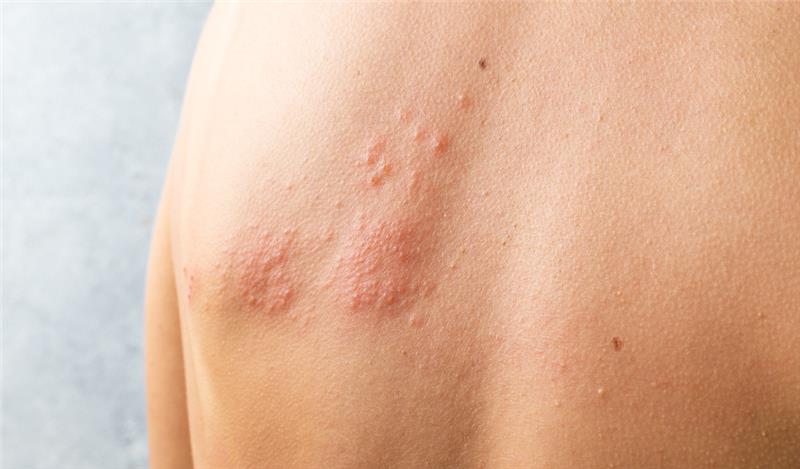 herpes nas costas