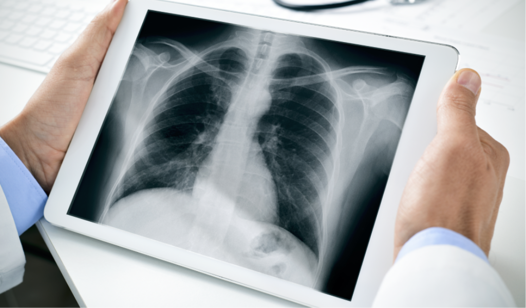 fibrose pulmonar