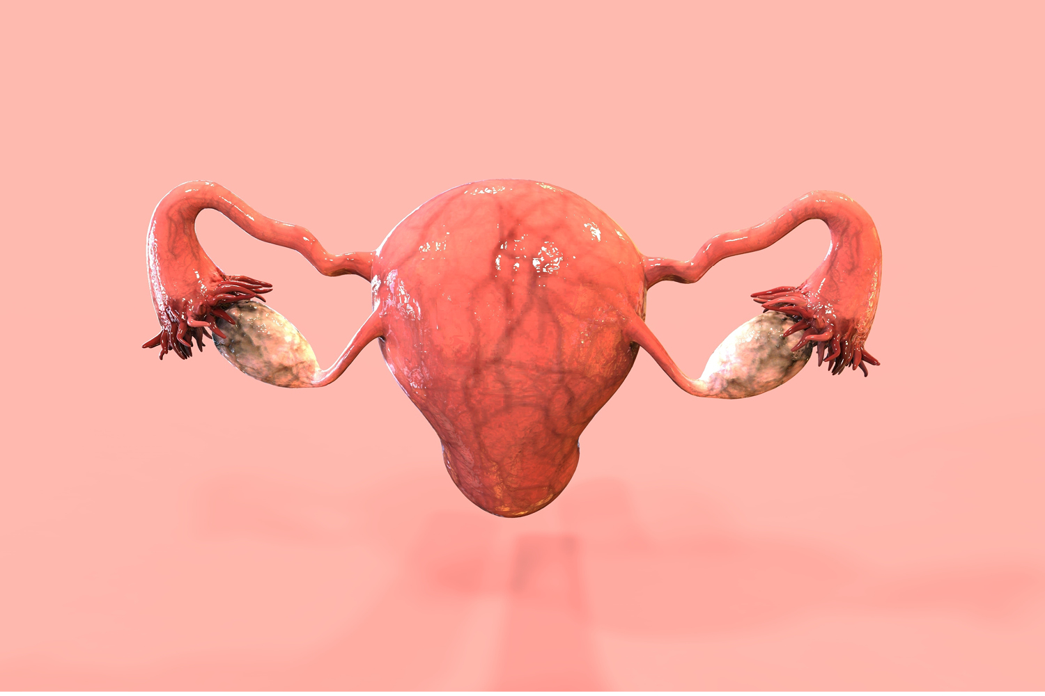 adenomiose